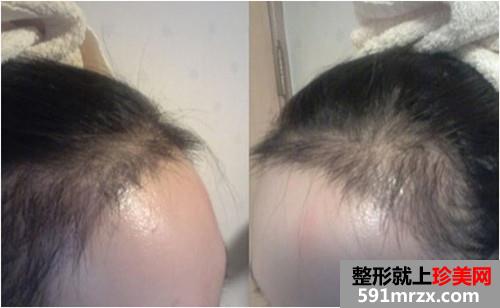 �l�H���Nֲ���gǰ��Ч�����ȈD�ͻ֏��^��