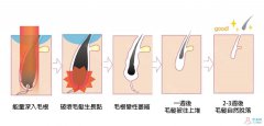 激光脫毛價(jià)格