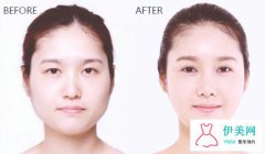 雙眼皮手術(shù)后會留疤嗎