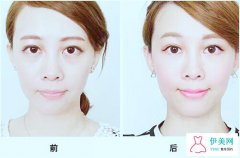 超聲波去眼袋手術(shù)會(huì)不會(huì)損傷眼睛