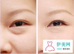 內(nèi)吸去眼袋的持續(xù)時(shí)間