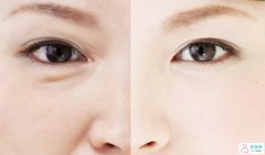 吸脂去眼袋的優(yōu)缺點(diǎn)