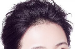 發際線太高怎么辦