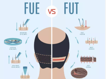 ����FUE�Nֲ�^�l�ļ��tԺ�ã�