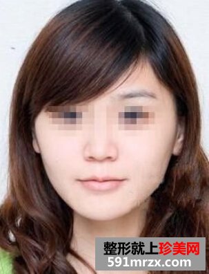 ���w֬����ֲ�S�����gǰ�󌦱�Ч���DƬ�ͻ֏��^��